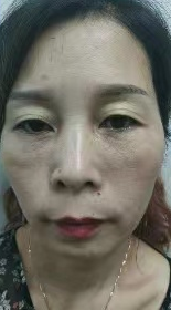 泪沟填充