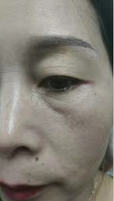 泪沟填充