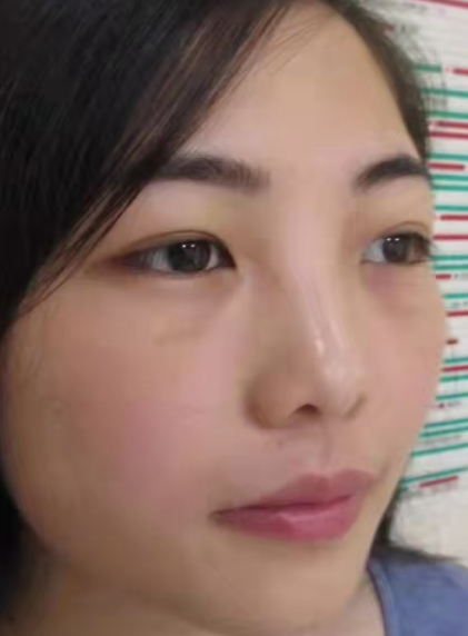 眼袋