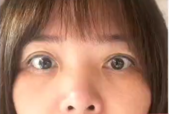 眼袋