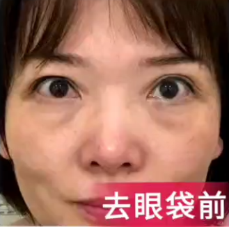 眼袋