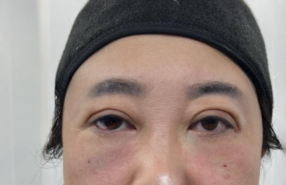 去眼袋手术