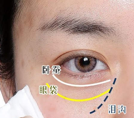 去眼袋手术