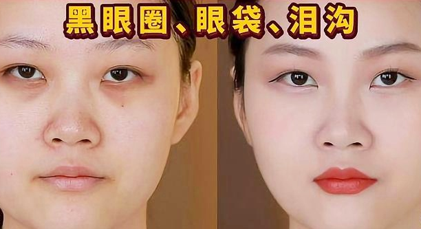 去眼袋手术