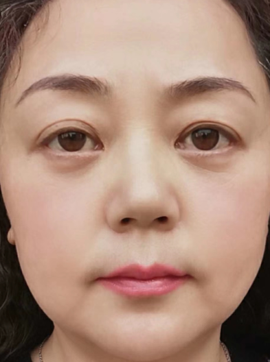 眼袋