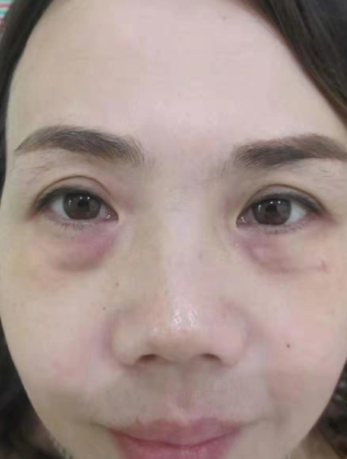 眼袋