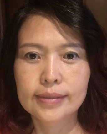 眼袋
