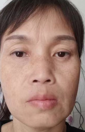 眼袋