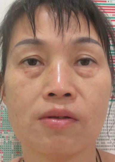 眼袋