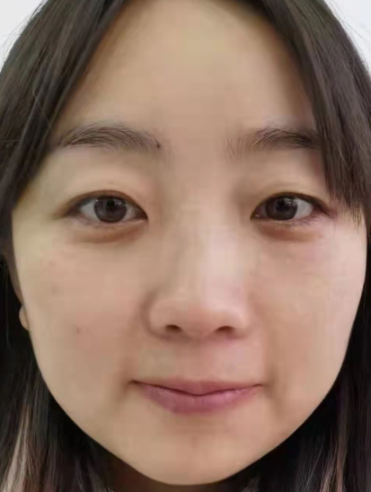 眼袋