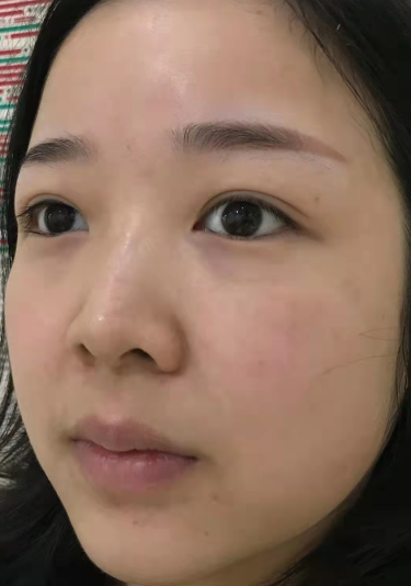 眼袋