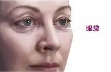 眼袋