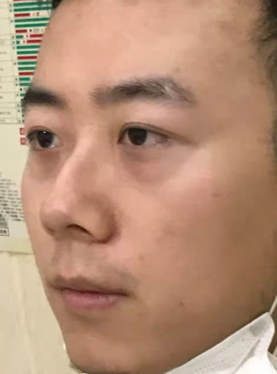 眼袋