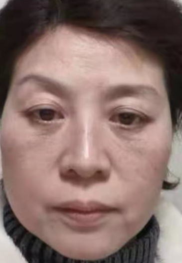 眼袋