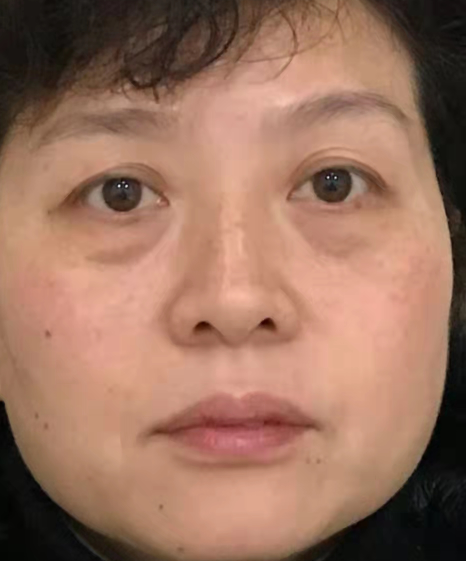 眼袋