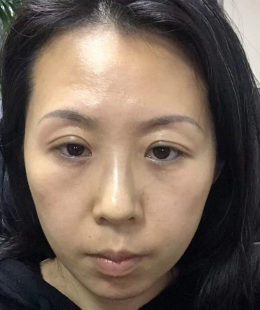 眼袋