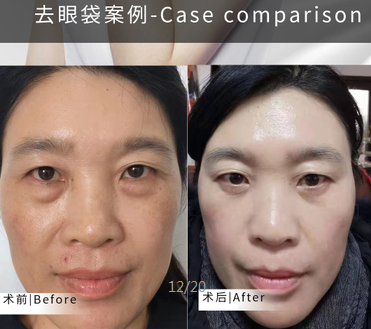 眼袋