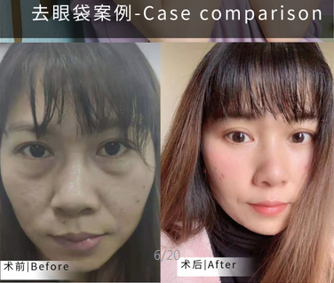 眼袋