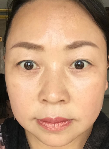 去眼袋手术