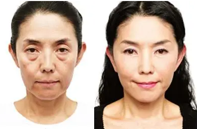 去眼袋手术