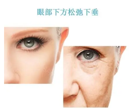 去眼袋手术