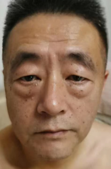 眼袋