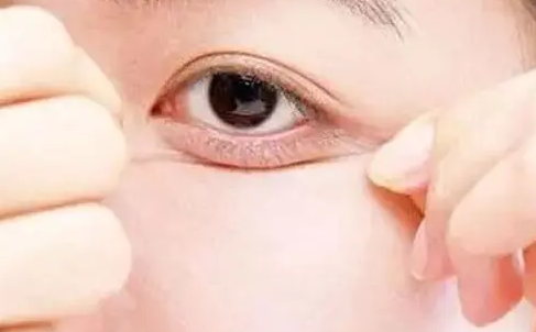 眼袋