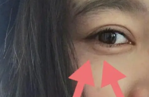 眼袋