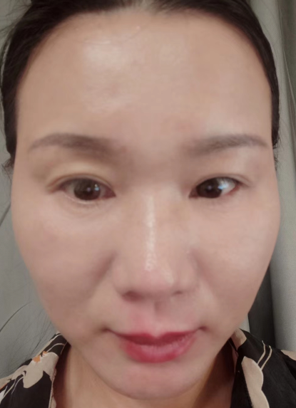 眼袋