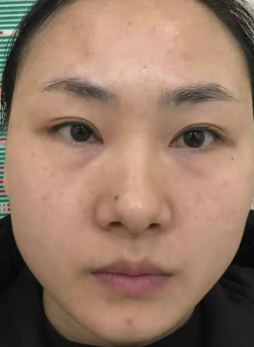 眼袋