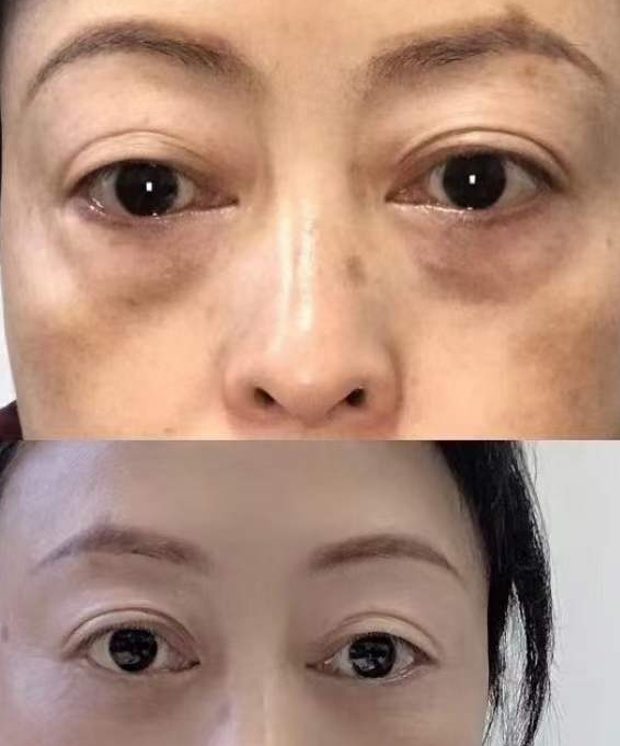眼袋