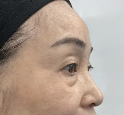 去眼袋手术