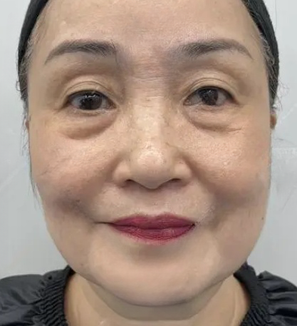 去眼袋手术