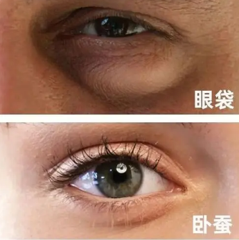 去眼袋手术