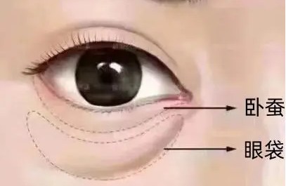 去眼袋手术
