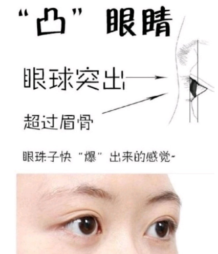 眼袋