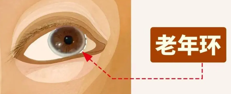 眼袋