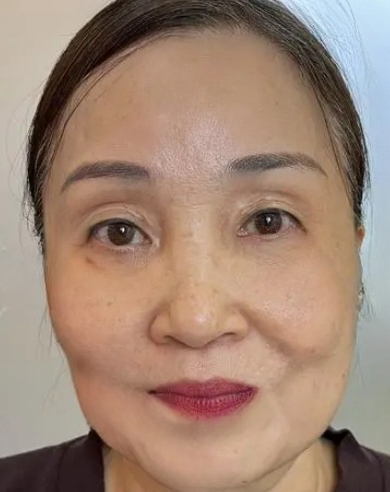 去眼袋手术