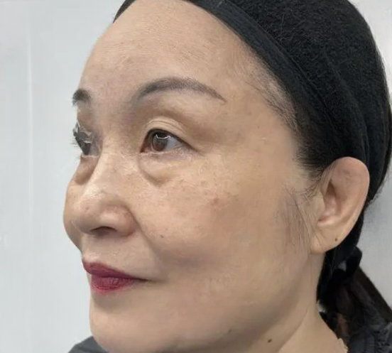 去眼袋手术