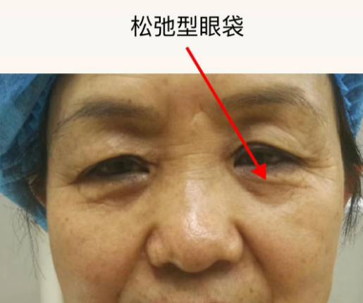 眼袋