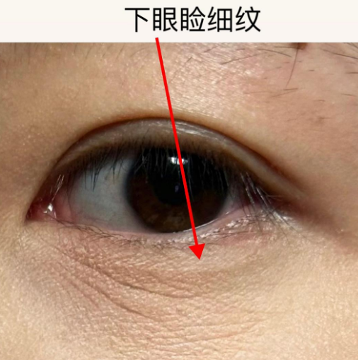 眼袋
