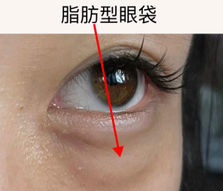 眼袋