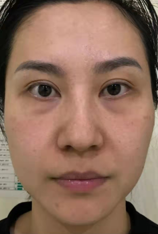 眼袋