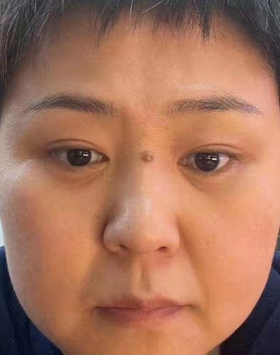 眼袋
