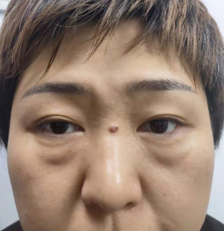 眼袋