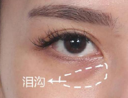 泪沟