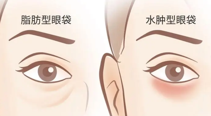 去眼袋手术