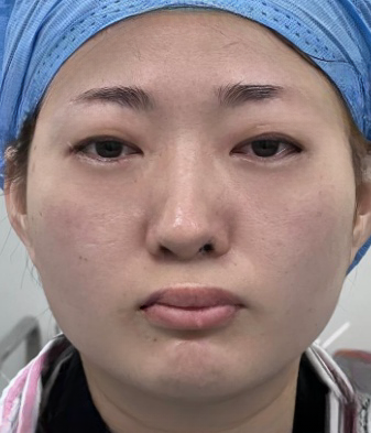 去眼袋手术