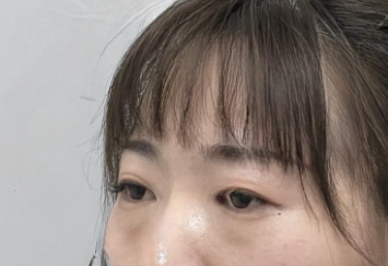 去眼袋手术