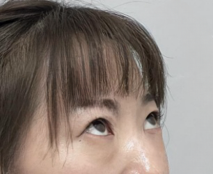 去眼袋手术